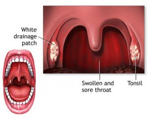 Strep throat Symptoms